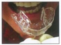Teeth Whitening 35% 6 Syringe & 3 D.I.Y. Moldable Tray Kit
