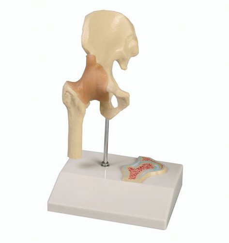 4523 Erler-Zimmer Mini Hip Joint Model with Cross Section