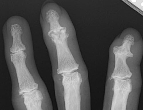 ARTHRITIS: Before the Cortisone Shot: Joint Inflammation, Calcium Deposition, and Your Body Healing Itself