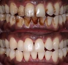 Nanni - Herbal Teeth Stain Remover | Tobacco Stain Remover | Freshens Laugh by Herbal