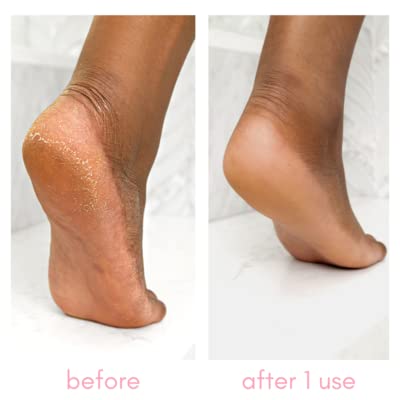 Kiara Sky Heeling Callus Remover Gel Salon Grade Home Pedicure Supplies for Rough, Dry, Cracked Skin, Heavy Duty Callus Remover for Feet 8 oz