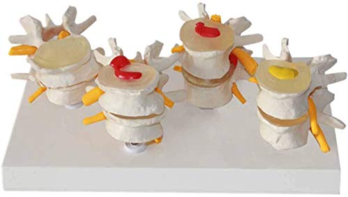 QIQIZHANG Anatomy Model, Human Anatomy Science Models, Human Lumbar Lesion Spine Statue Display Model Lumbar Model Spine Model Medical Educational Training Aid Tool for Medical Demonstration