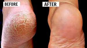 Image of 100% Pure White Petroleum Jelly IP - 500 gms - For Psoriasis, Cracked Heels, Dry Skin, Face & Chapped Lips, Diaper Rash, Sanitary Napkin Rash, Bed Sores, Bruises, Small Cuts and Burns. No Smell, pH 5.5, No skin allergy. Expiry 5 years. - (See Video). - (NOTE: Due to Iran-US war, price and availabiliity may vary). (Medium)