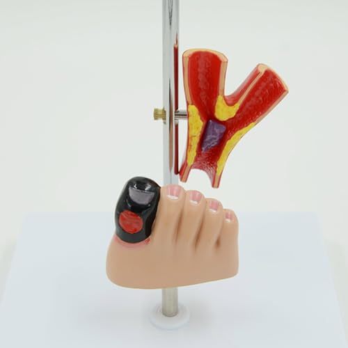 Modèle anatomique de pathologie rénale pour expliquer les lésions