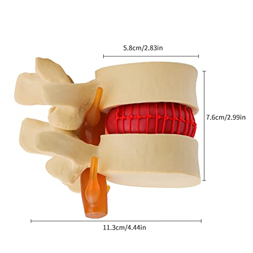 Image of Disc Herniation Model - Human Lumbar Disc Herniation Spine Model 1.5X Intervertebral Disc Model Anatomical Vertebrae Disc Model with Elastic Software