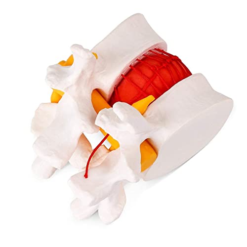 Image of Premium ✮ Lumbar Disc Herniation Model ✮ Lumbar Spine Model for Teaching & Learning ✮ Excellent Way for Demonstrating Herniated Lumbar Disc