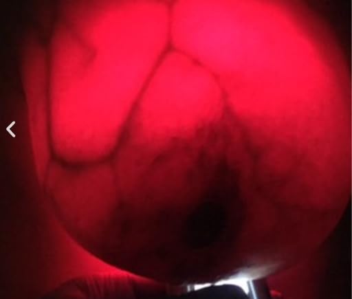 Équipement médical de diagnostic mammaire Luminous à LED rouge - 6