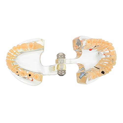 DOITOOL Tandheelkundig implantaat Tanden Model Transparante Volwassen Pathologieën Implantaat Demonstratie Tanden… - Image 3