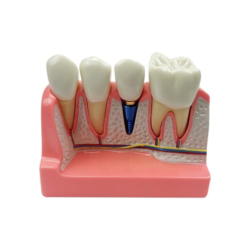 SENLIN DENTAL 4 Times Dental Implant Model, Removable Teeth Model, Dental Implant, Crown and Bridge Model for Demonstration of Tooth Structure