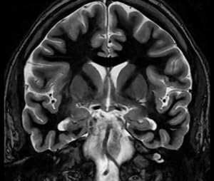 Episode 36 MRI of the Central Nervous System