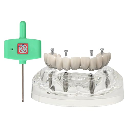 Dental Implant Model Upper All-on-4 Metal Framework Treatment Model with Detachable Overdenture Implants and 4 Screw Post Core Bridges M6023