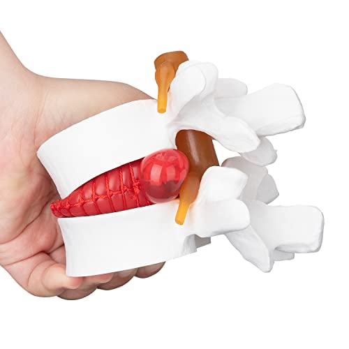 Image of Disc Herniation Model - 1.5X Lumbar Herniated Disc Model Vertebral Spine Anatomical Medical Model