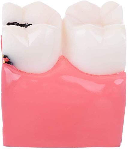 Insegnamento del Modello di Anatomia Dentale Educazione per Studenti di Odontoiatria E Ricerca sulle Carie 6 Volte Studio Comparativo del Modello 1 Strumento Assistente di Biologia Anatomica