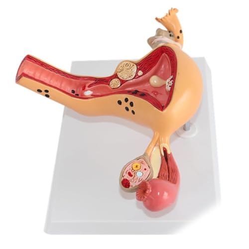 Modèle pathologique utérus ovarien pédagogique pour cours - 5