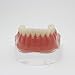 Dental Teeth Model Precision 4 Implant Overdenture Inferior Tooth Golden Color