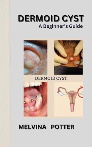 DERMOID CYST: A Beginner’s Guide (English Edition)