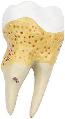Model Zębów Próchnicy, Model Zębów Dentystycznych Do Badania Anatomii Zębów Dentystycznych, Edukacji Lekarza-pacjenta I Higieny Jamy Ustnej,Serene16