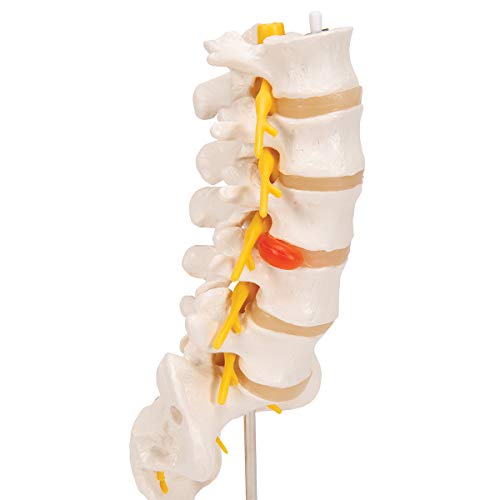 Image of 3B Scientific A76 /5 Lumbar Spinal Column with Dorso-Lateral Prolapsed Intervertebral Disc, 13.4 inch Height