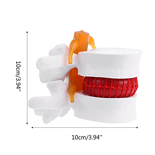Lumbar Disc Spine Anatomical Model, Human Lumbar Disc Herniation Model, 1:1.5 Model of Lumbar Vertebral Spine Lumbar Disc Model for Linical Teaching Medical Demonstration