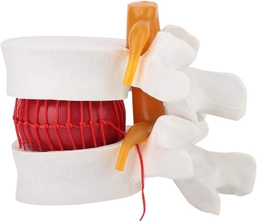 Modèle de hernie discale lombaire pour illustrer la compression