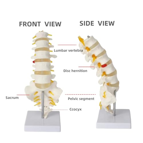 Image of Human Anatomical Lumbar Disc Herniation Model Life Size Lumbar Spine Model for Teaching and Learning (Spine-Tall)