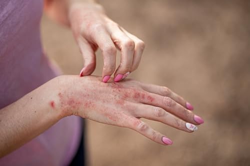 EKU Podcast: Eczema