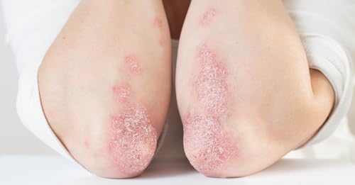 Giornata Mondiale della Psoriasi