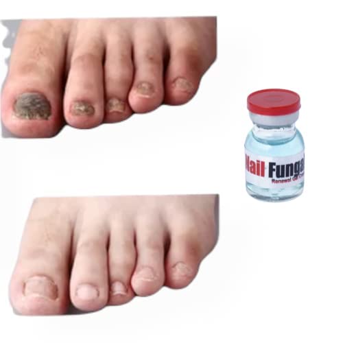 Nail Damage Repair | Nail Care Serum Repair Fungal | Nail Care Serum Repair | Nail Growing Serum