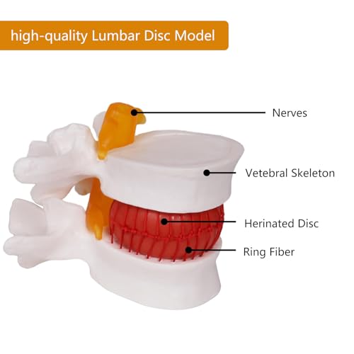 Modèle de disque hernié lombaire AMITD pour expliquer la compression nerveuse - 6