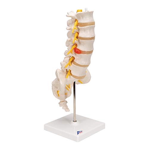 Image of 3B Scientific A76 /5 Lumbar Spinal Column with Dorso-Lateral Prolapsed Intervertebral Disc, 13.4 inch Height