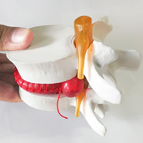 Gamino Modelo de hernia de disco, modelo de disco de vértebras con software elástico, modelo médico de hernia lumbar 1.5X modelo médico de columna vertebral