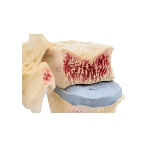Modèle lombaire ostéoporose AMITD démo pathologique apprentissage anatomie