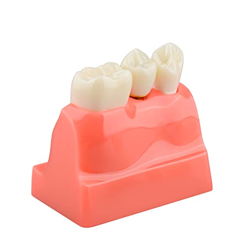 Dental Implant Model with Crown Bridge and Removeable Crowns for Education-Normal