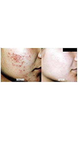 30% and 50% Glycolic Acid (Professional Medical Grade) Chemical Peel with Fanbrush - Age Spots,Lines,Wrinkles,Acne - LeWilnet