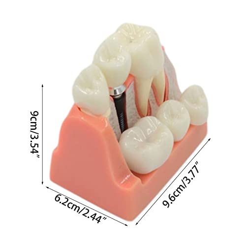 Modèle d'implant 4 fois avec structures anatomiques pour enseignement