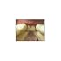 Opalescence PF 20% Teeth Whitening 16pk & 3 D.I.Y. Tray Kit