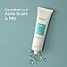 METROL RE' EQUIL Pitstop Gel for Acne Scars Removal and Acne Pits Removal - 30g
