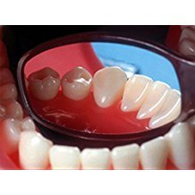 Pulpdent Flecta Disposable Mirrors (50)