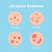 Saplaya K-Beauty Ance Care Hydrocolloid Patches For Acne Pimple Care 100% Hydrocolloid Acne Spot Healing Patch