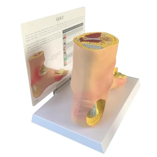 Modelo de pie de gota de tamaño real con tophi articular para enseñanza médica, anatomía patología, pie con soporte, herramienta de aprendizaje de juanetes y podología, simulación de tablero de uñas