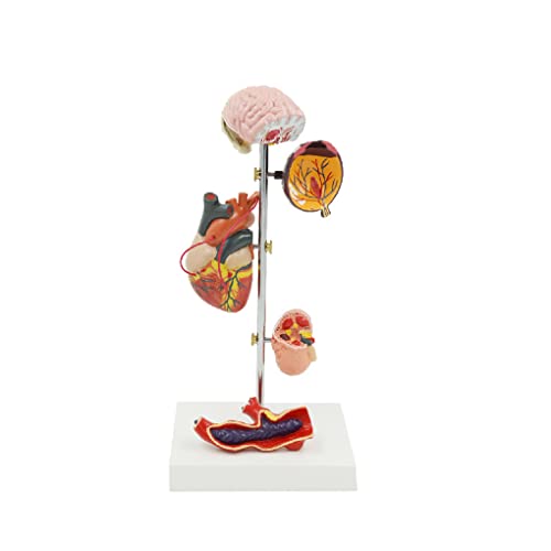 Teaching Model Tools,Pathological Model of Human Hypertension 5 Parts Brain Eye Heart Kidney Blood Vessel PVC Life-Size Human Kidney Organ Anatomy Model Educational 16.5 * 12 * 36C
