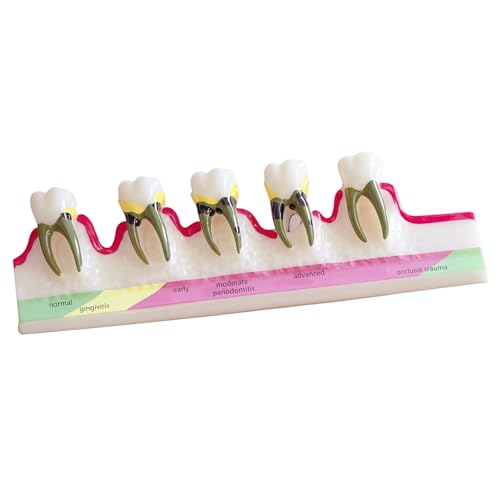 Image of Periodontal Disease Classification Model, 5-Stage Dental Anatomy Model for Dental Education,Dental Training,Demonstrations,Oral Care Education
