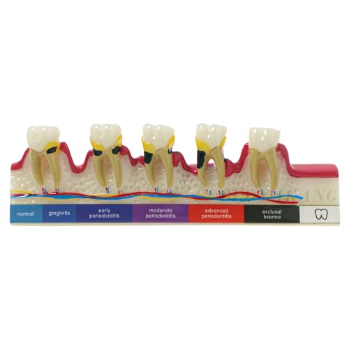 Dental Typodont Periodontal Disease Dental Caries Developing Model Dental Teeth Model for Dental Tooth Anatomy Study Doctor-Patient and Oral Care Education (M4026 Periodontal Disease Teeth Model)