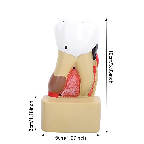 Mondelinge cariës Model Tandziekte Tand Model Tand Profiel Model Cross-Section Uitgebreid met Zenuw voor Tandarts Studie… - Image 7