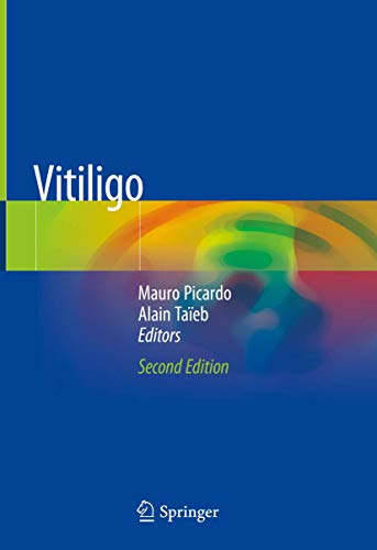 Vitiligo view 2