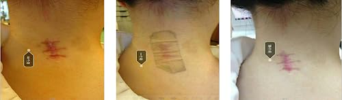 Gel silicone cicatrices 100% qualité médicale pour retrouver une peau nette au quotidien - 7