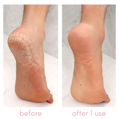 Kiara Sky Heeling Callus Remover Gel Salon Grade Home Pedicure Supplies for Rough, Dry, Cracked Skin, Heavy Duty Callus Remover for Feet 8 oz