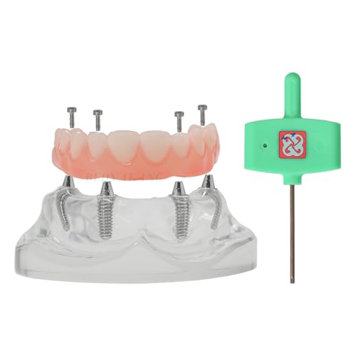 Dental Typodont Model Overdenture Implant Simulator, Upper Jaw, Detachable, 4 Screws Post Core Bridge, Comes with a Hex Driver Screwdriver