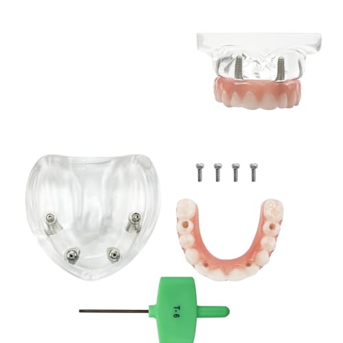 Modèle d'implant dentaire All-On-4 Malone Bridge 6001 pour cabinet de haute précision