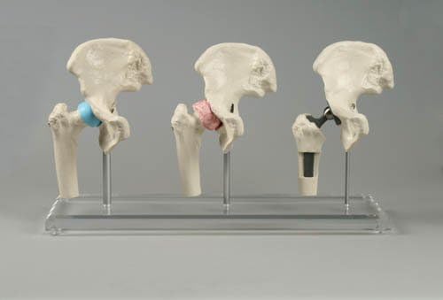 Hüft-implantat-modell